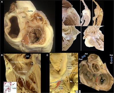 State-of-the-Art Review: Anatomical and Imaging Considerations During Transcatheter Tricuspid Valve Repair Using an Annuloplasty Approach